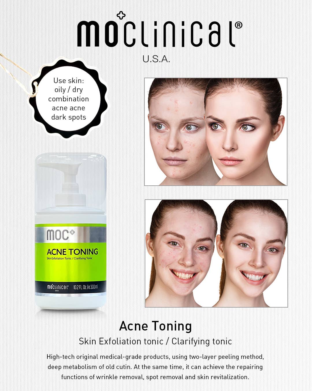 MO Clinical Acne Toning